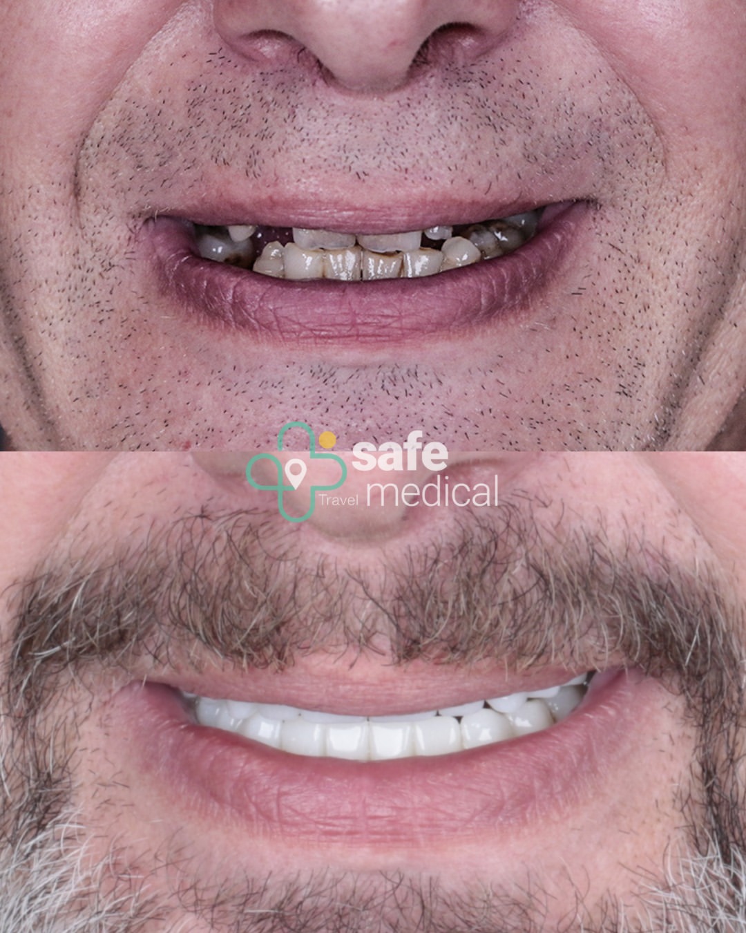 dental-implant-in-turkey before and after-9