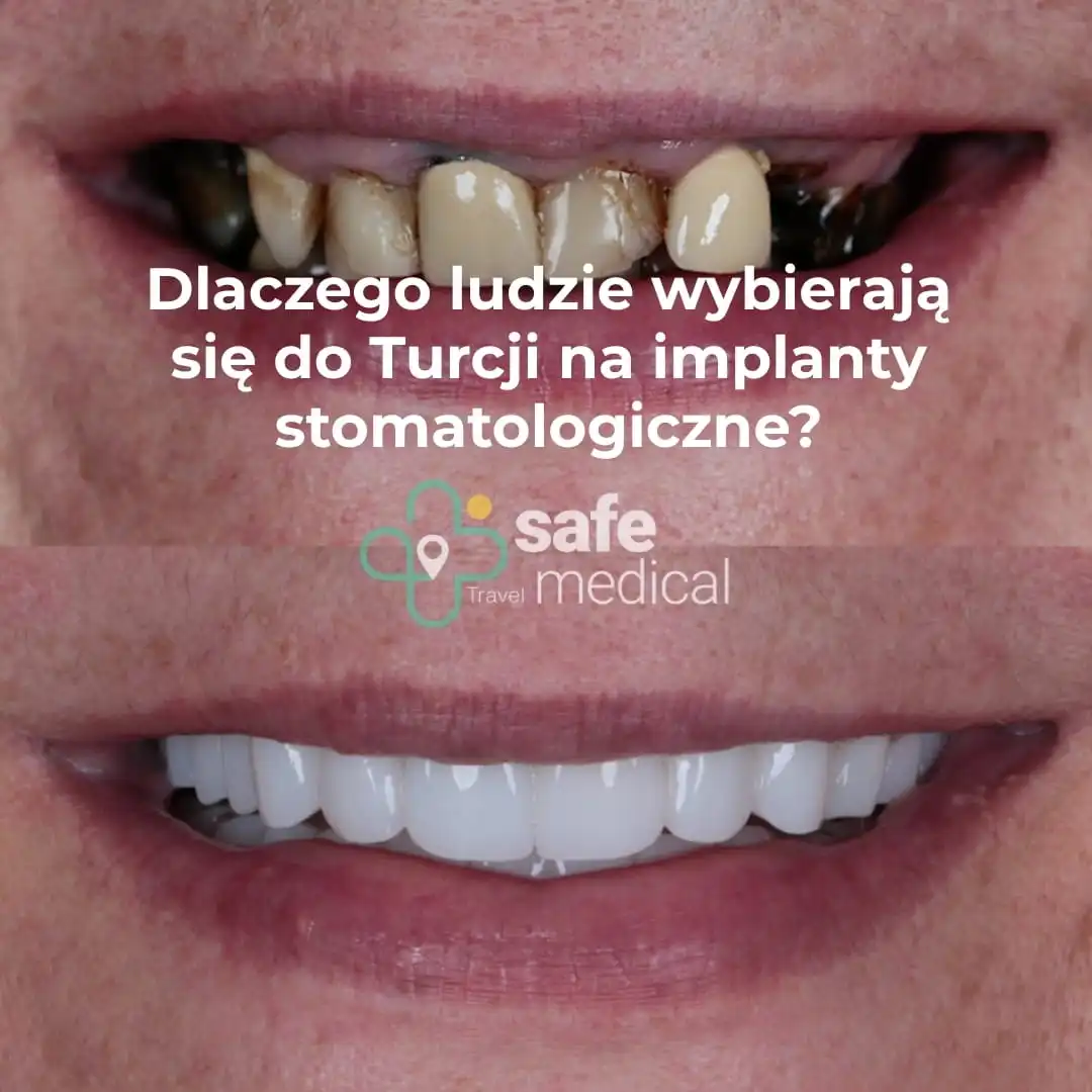 Dlaczego ludzie wybierają się do Turcji na implanty stomatologiczne?
