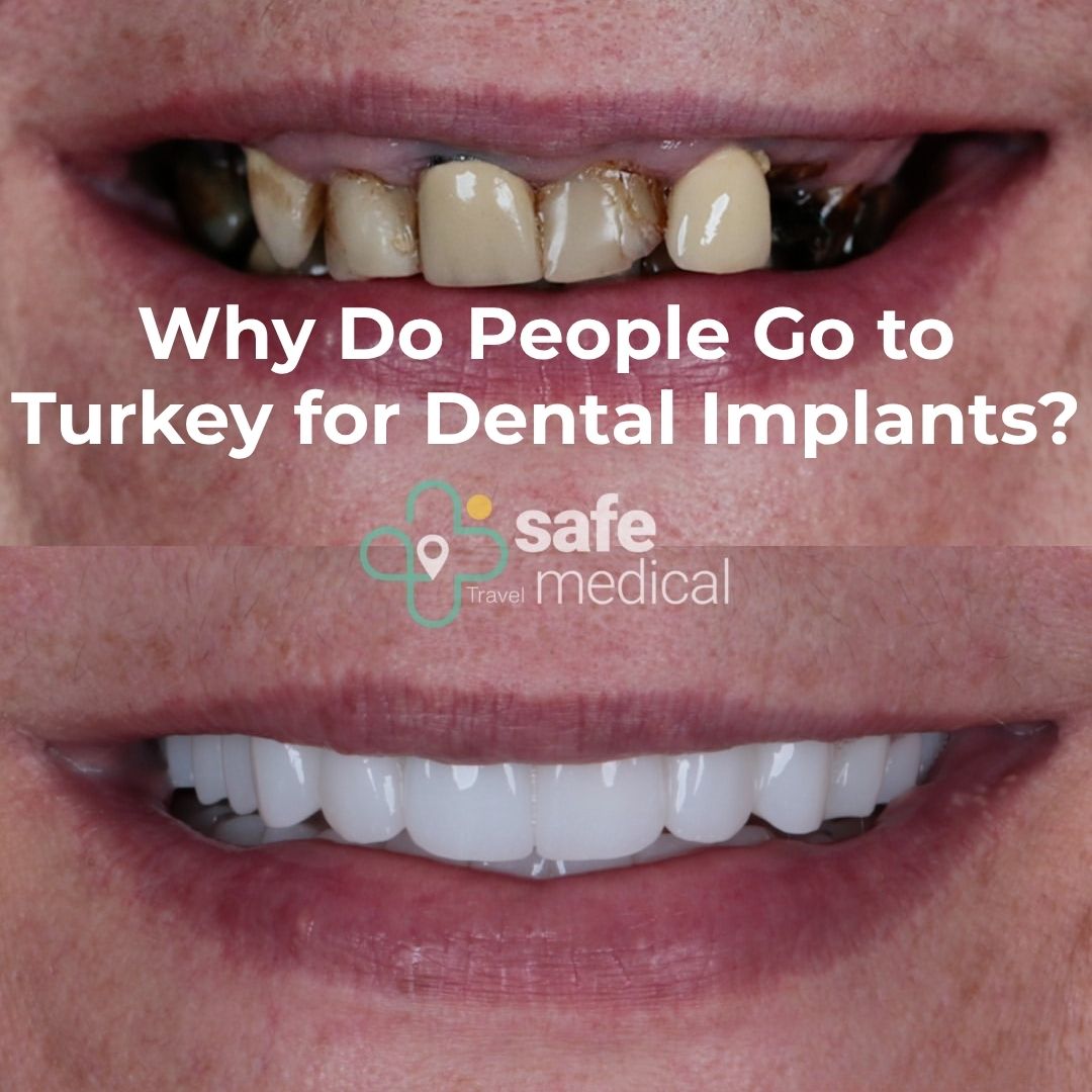 Why Do People Go to Turkey for Dental Implant?