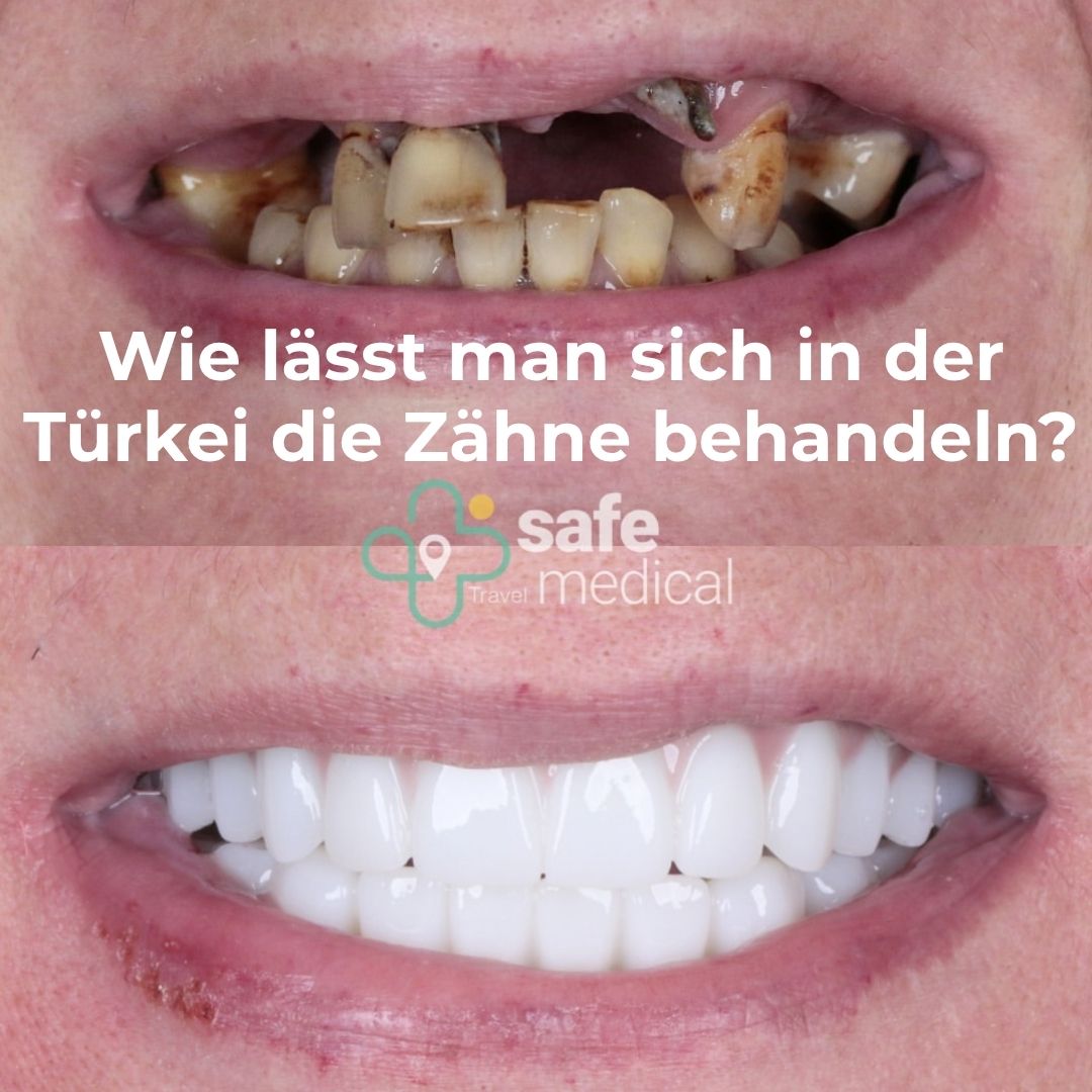 Zahnbehandlungen in der Türkei