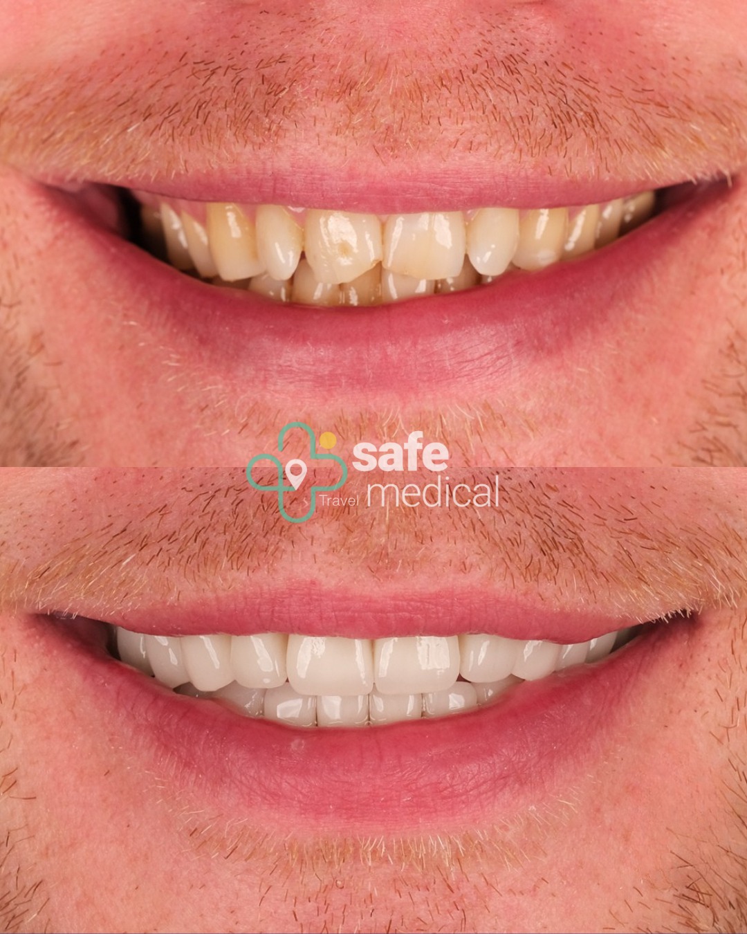 zirconium-crowns-turkey before and after-1