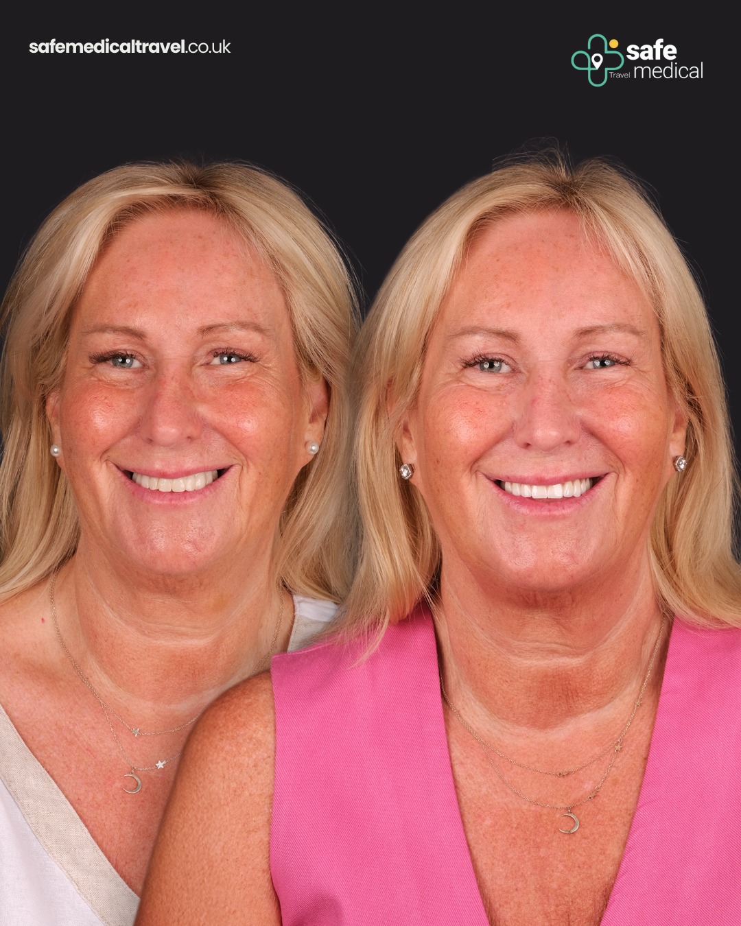 zirconium-crowns-turkey before and after-10