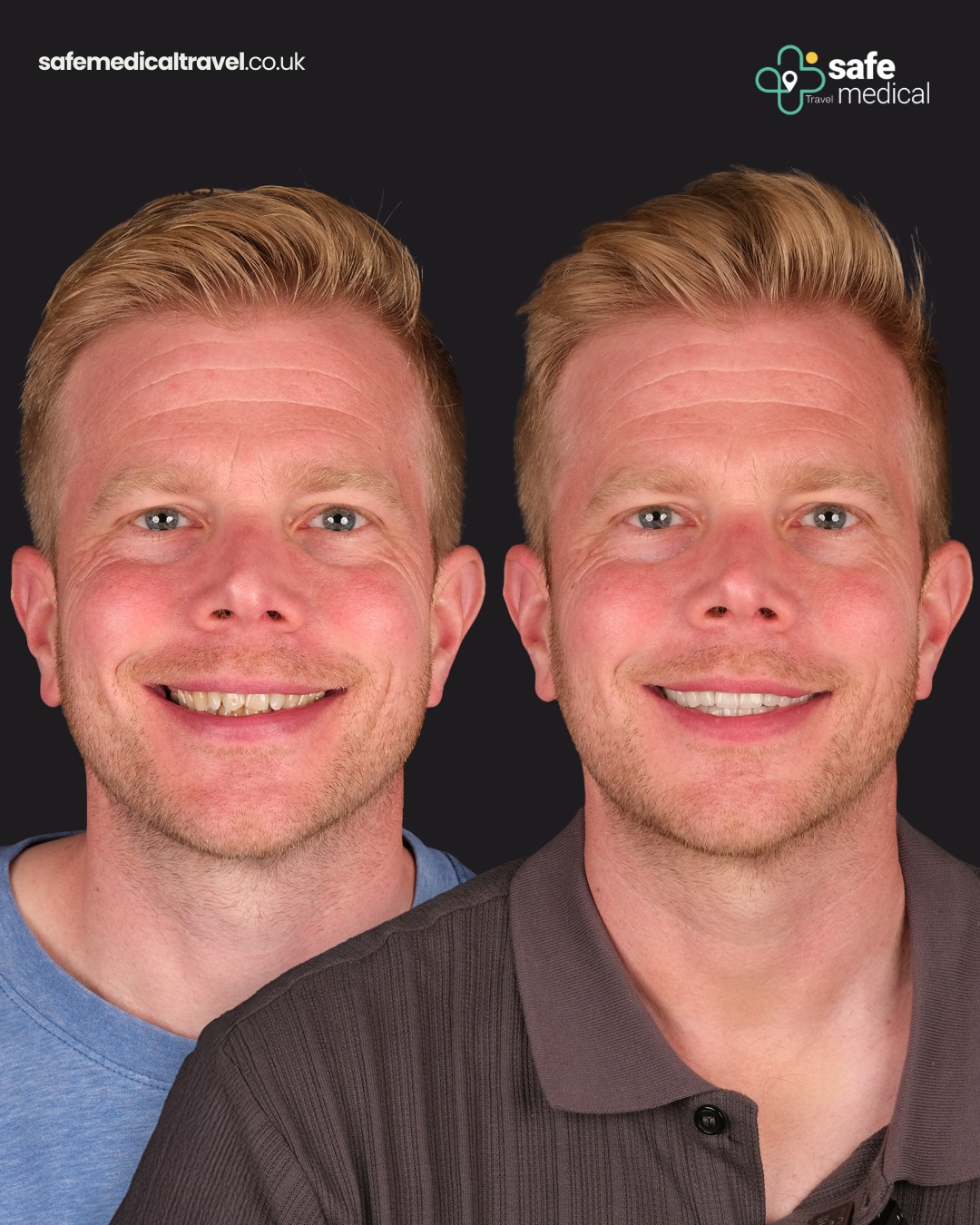 zirconium-crowns-turkey before and after-2