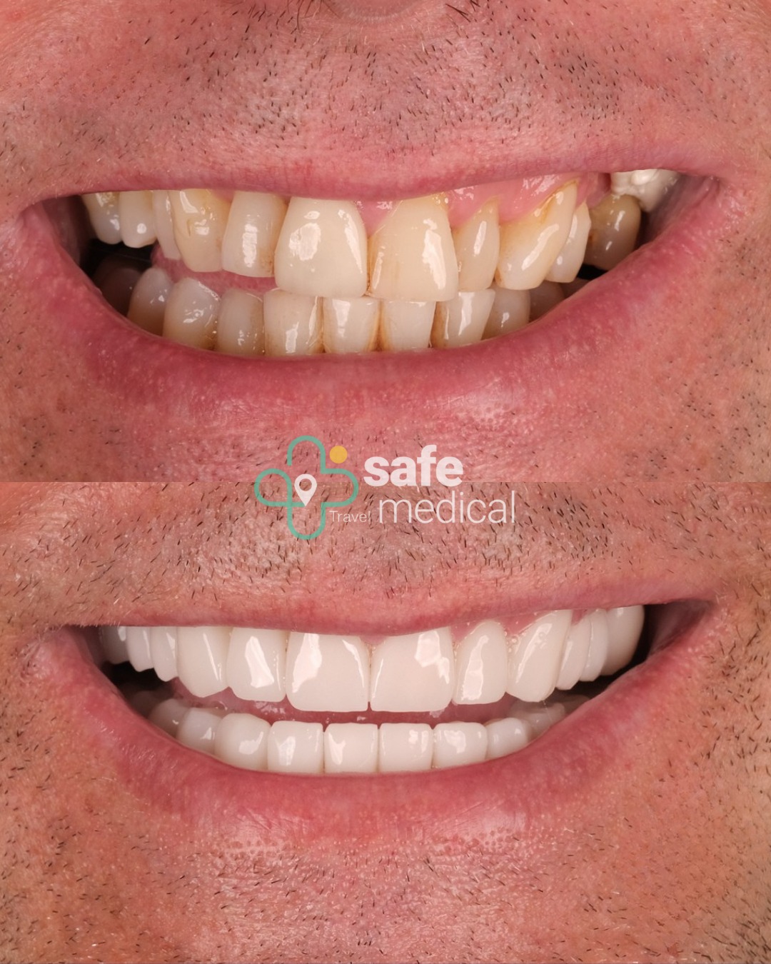 zirconium-crowns-turkey before and after-3