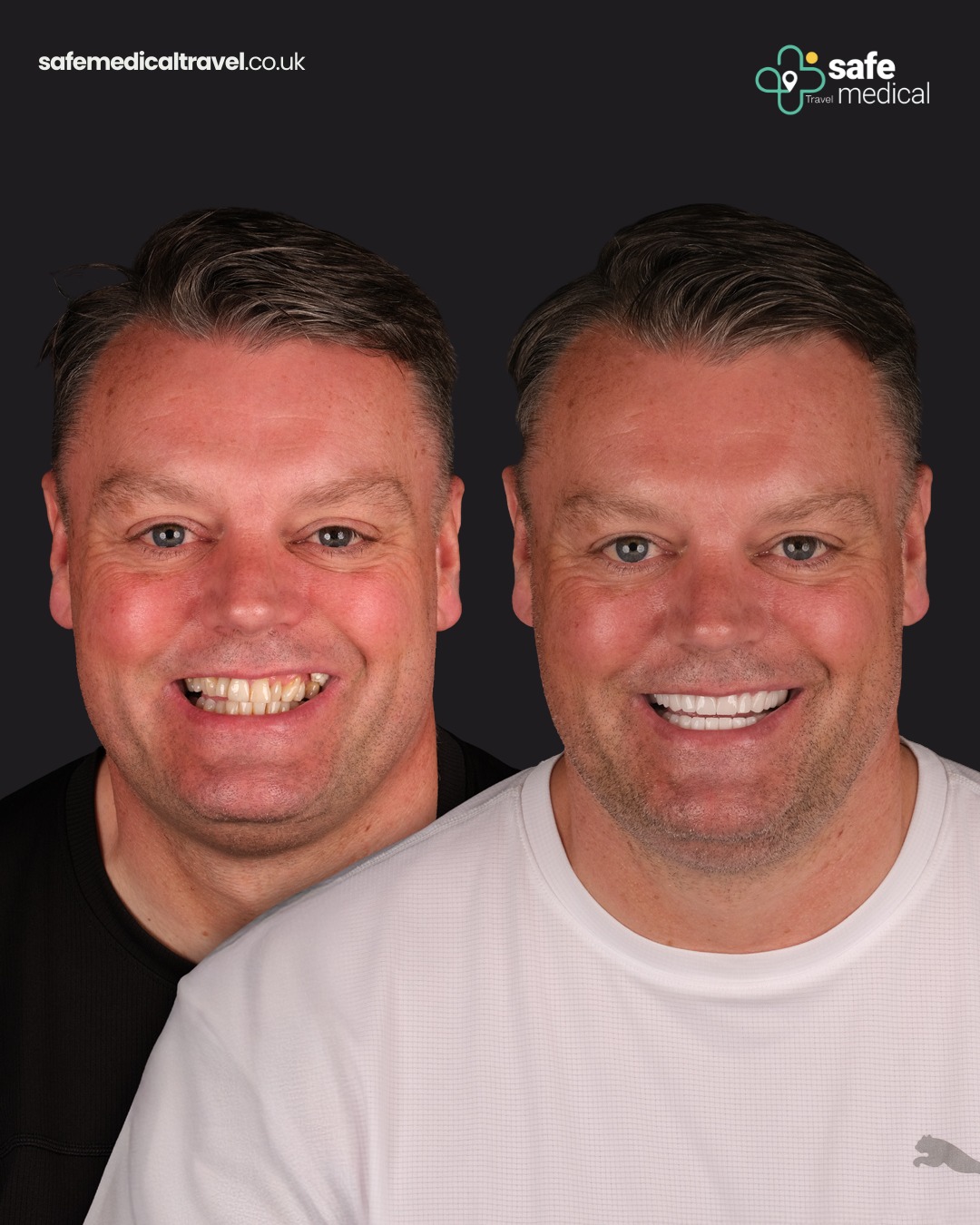 zirconium-crowns-turkey before and after-4