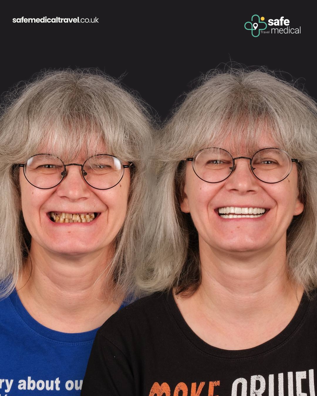 zirconium-crowns-turkey before and after-6