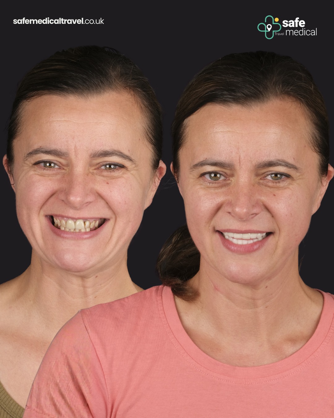 zirconium-crowns-turkey before and after-8