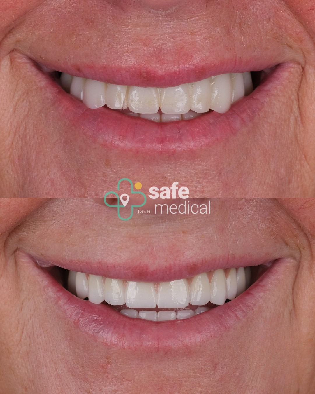 zirconium-crowns-turkey before and after-9
