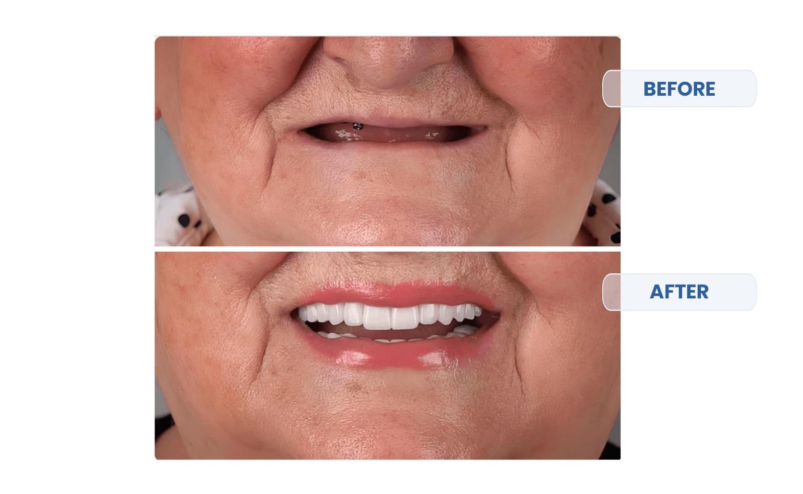 Zygomatic Implants Before and After 