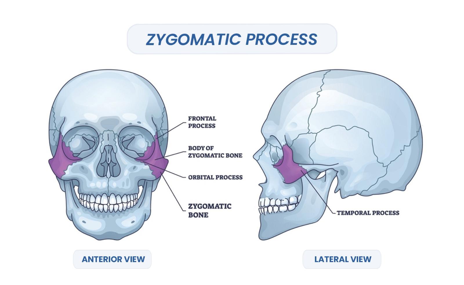 Zygomatic Implant Procedure 