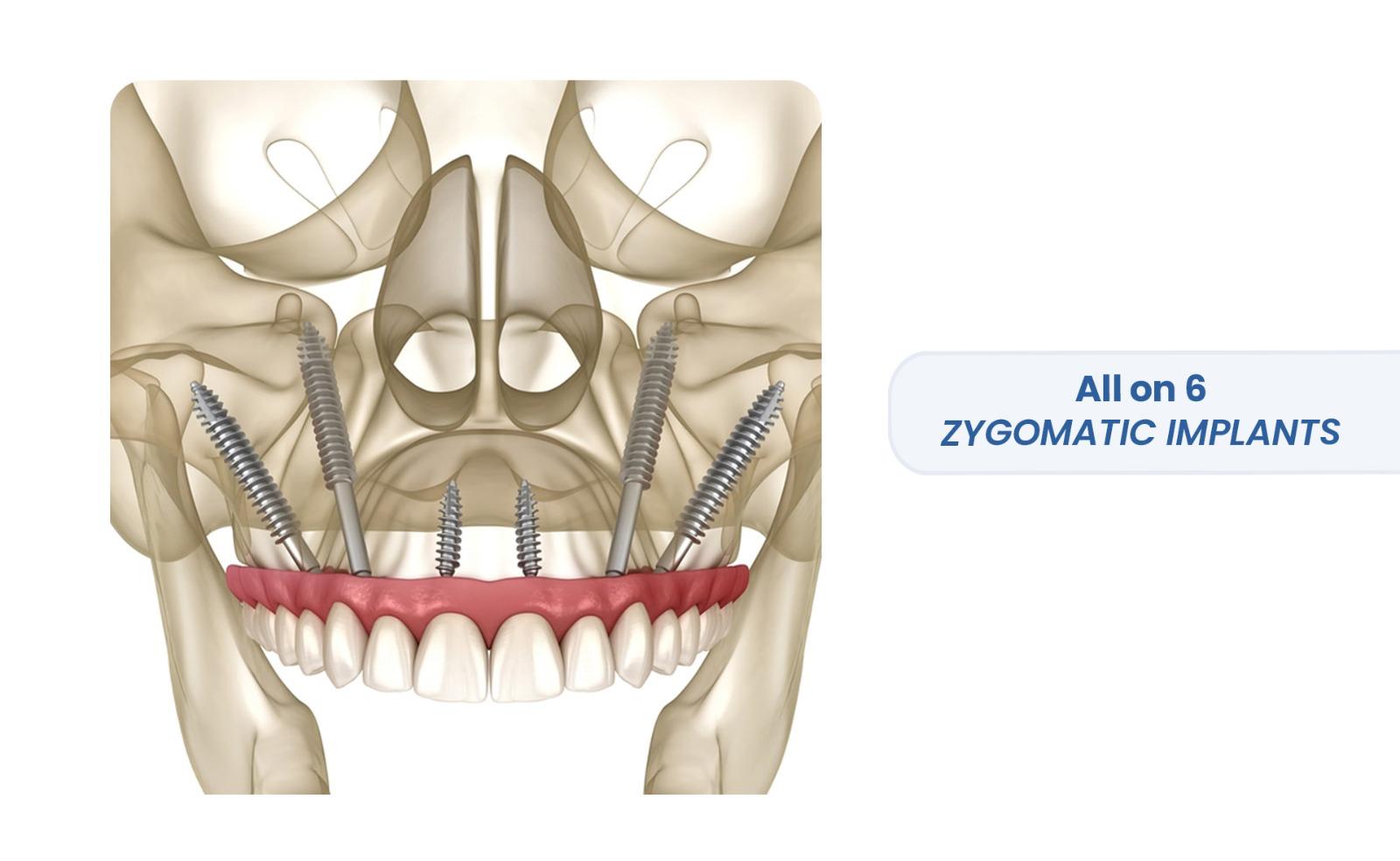 All on 6 Zygomatic Dental Implants
