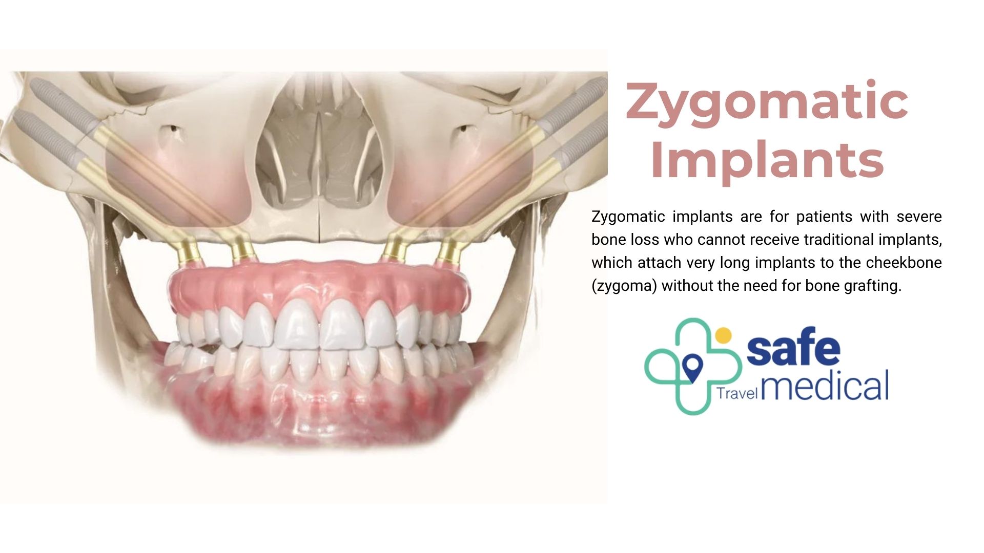What are Zygomatic Dental Implants?